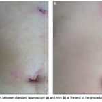Mini laparoscopy scarsmini laparoscopy for gallbladder removal (cholecystectomy)