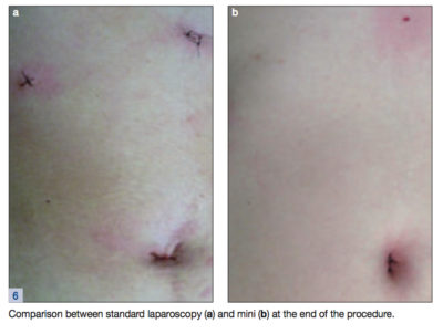 mini laparoscopic scar comparison
