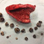 thickened and infected galbladder wall with multiple gallstones