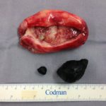 thickened and infected gallbladder with large gallstone