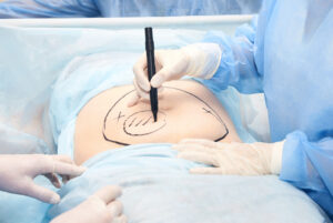 Colorectal Surgery