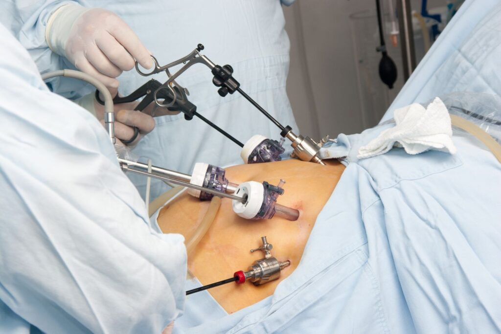 Bariatric Surgery