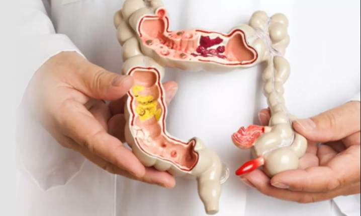 Colorectal Conditions