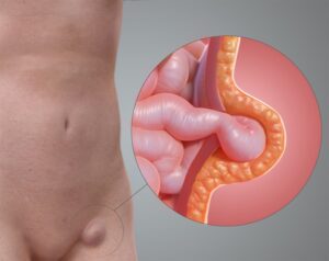 Hernia Conditions