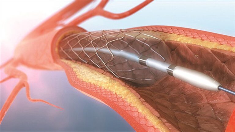 Stenting and dilatation